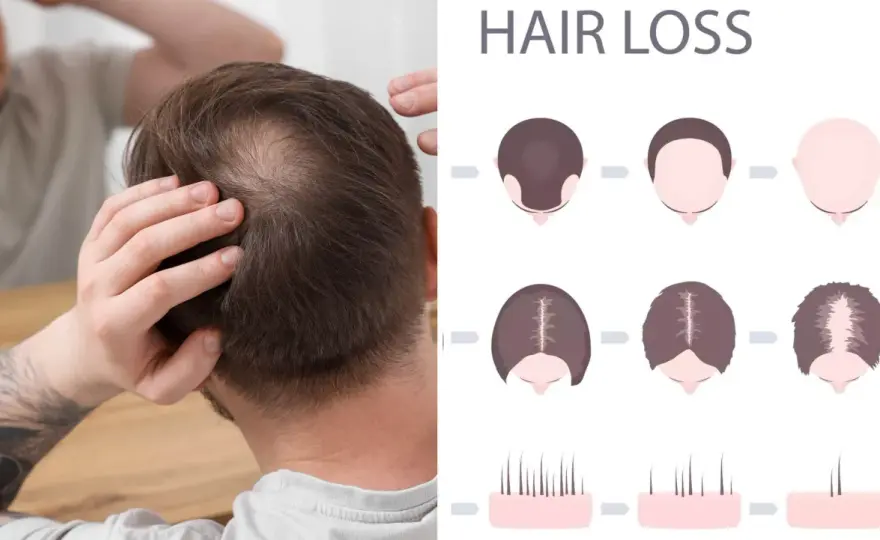 Alopecia areata behandling - Få tillbaka håret? Din guide i Sverige