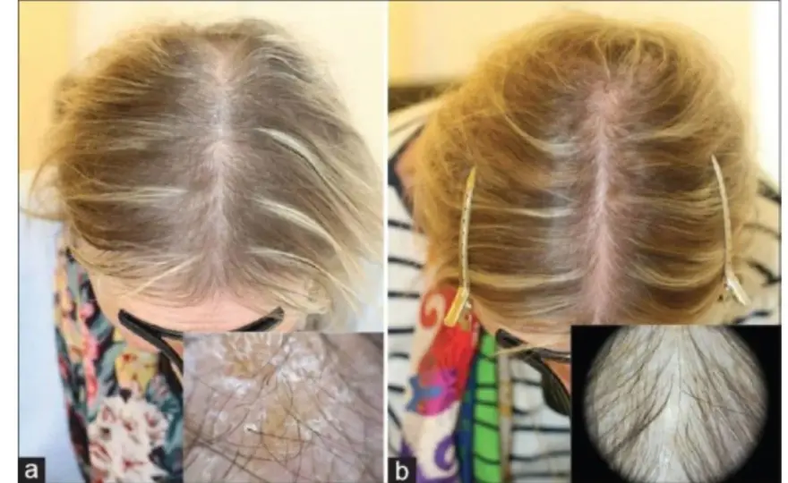 Biotin mot håravfall - När hjälper det egentligen?