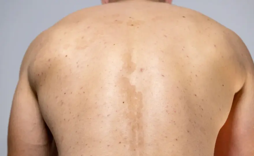 Pityriasis versicolor - Färgskiftande fläckar? Så blir du av med dem!