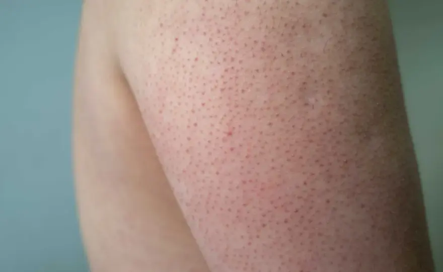 Knottrig hud - Keratosis pilaris: Vad hjälper och när söka vård?