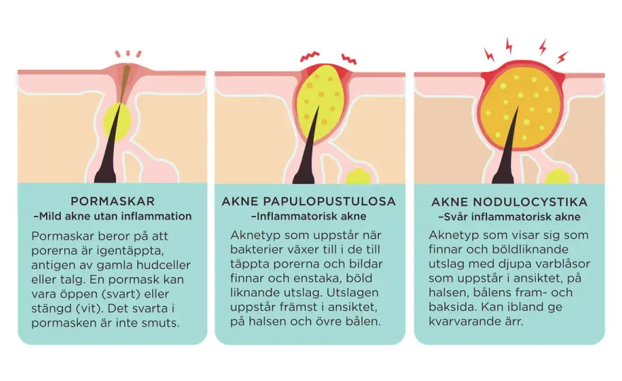 Finnar - Därför uppstår de & så får du bukt med dem
