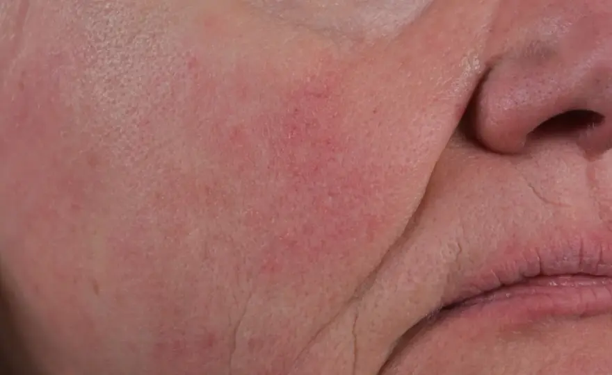 Ansiktsutslag - Känna igen akne, rosacea, eksem & mer