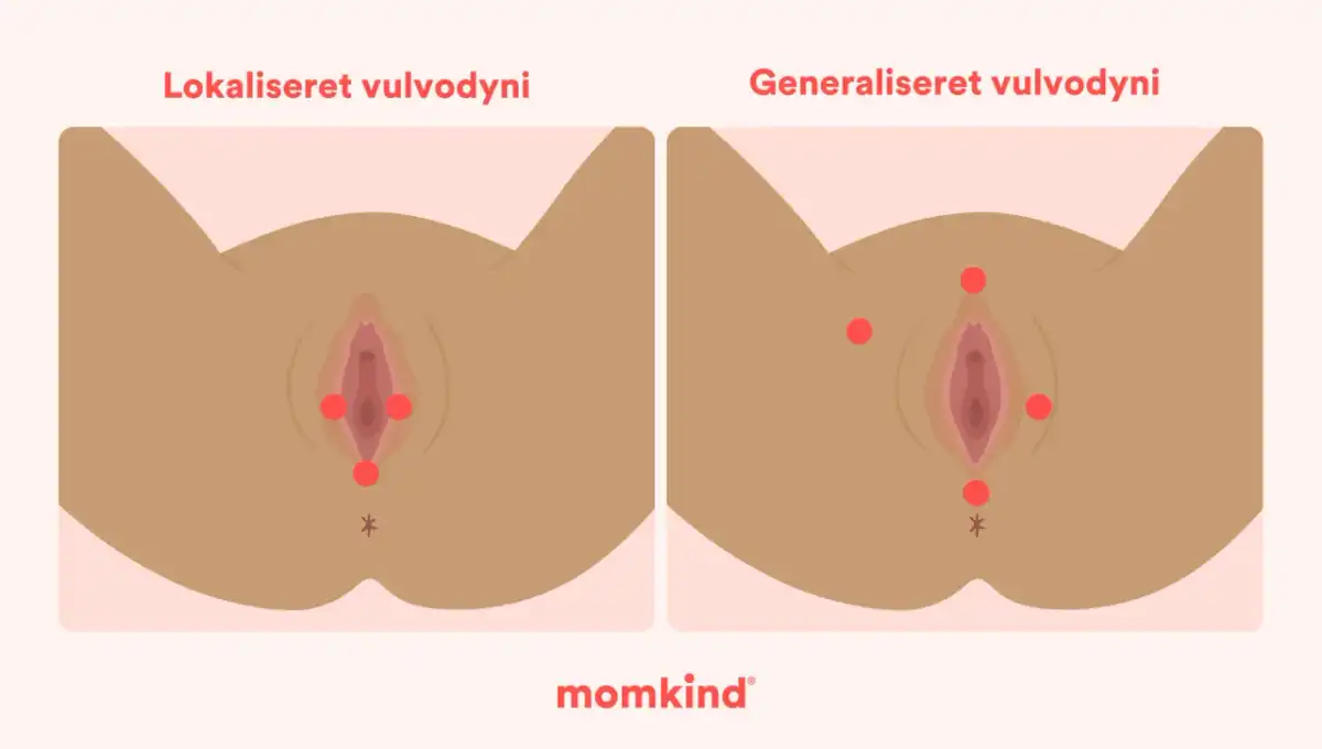 Sveda i underlivet - Orsaker, lindring och när du söker vård