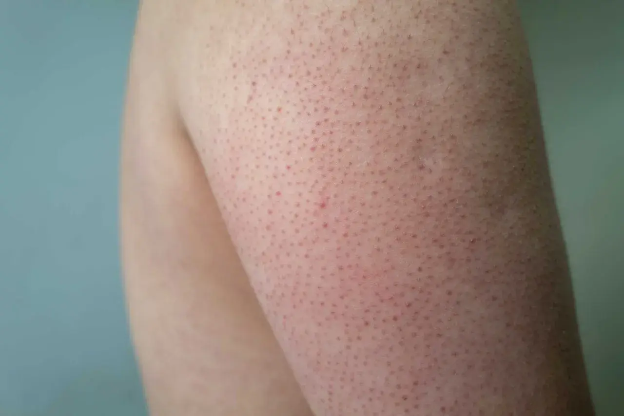 Närbild på arm med keratosis pilaris. Små röda prickar syns tydligt, vilket indikerar behov av keratosis pilaris behandling.