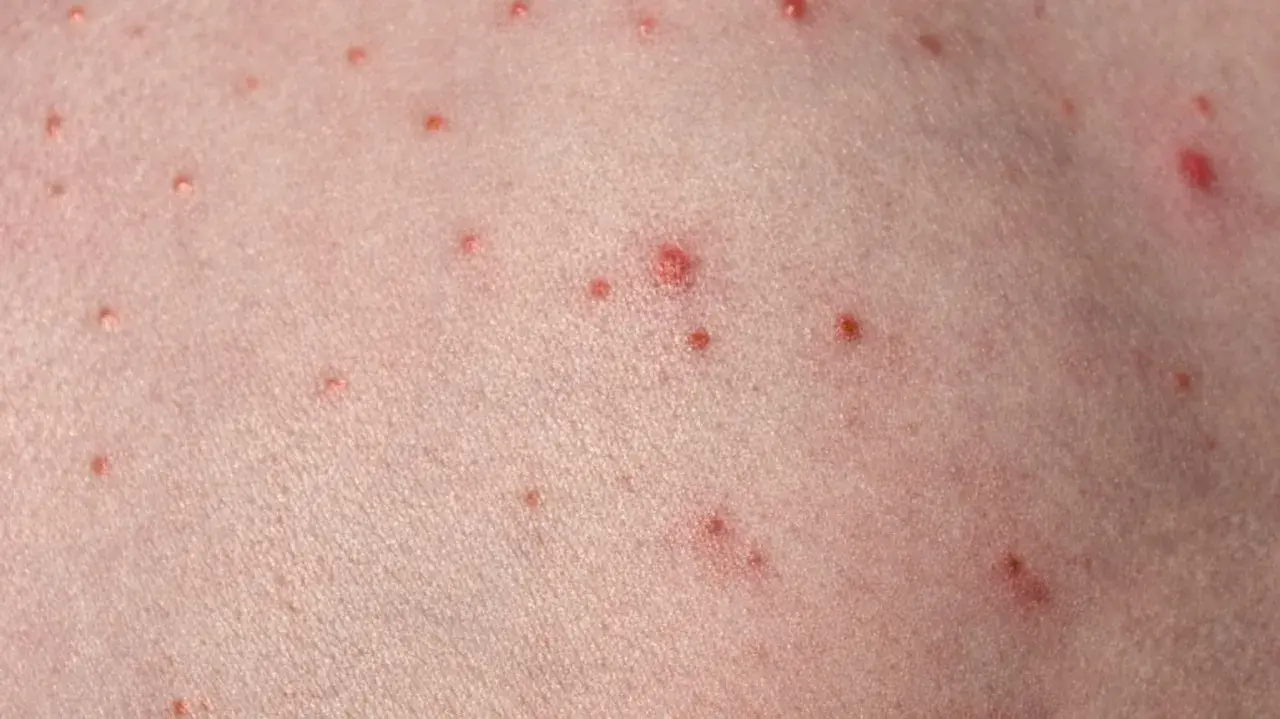 Närbild på hud med många små röda prickar, som kan likna finnar på halsen.
