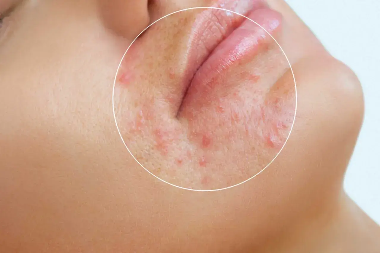När perioral dermatit blossar upp kan stress vara en bidragande orsak. Bilden visar rodnad och små utslag runt munnen.