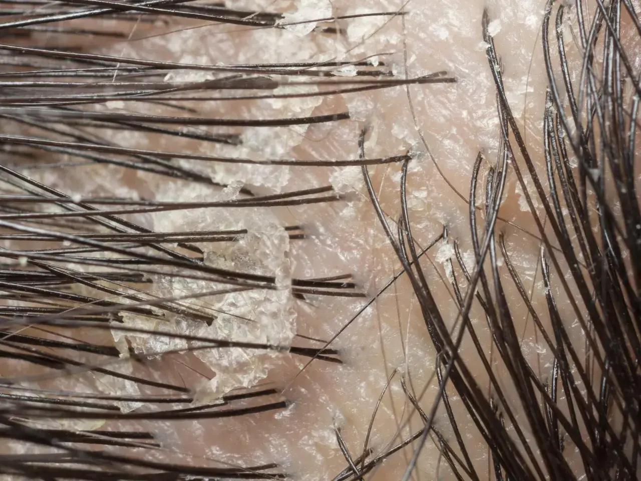 Närbild på hårbotten med fjällande hud, som kan vara tecken på svamp eller psoriasis.