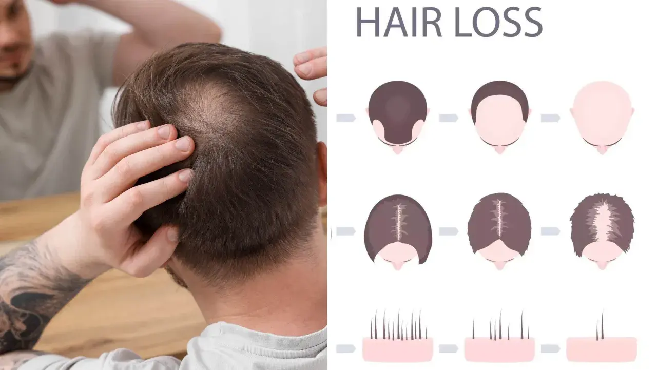 Man undersöker sitt tunnare hår. Illustrationer visar olika stadier av håravfall, vilket kan vara relaterat till alopecia areata behandling.
