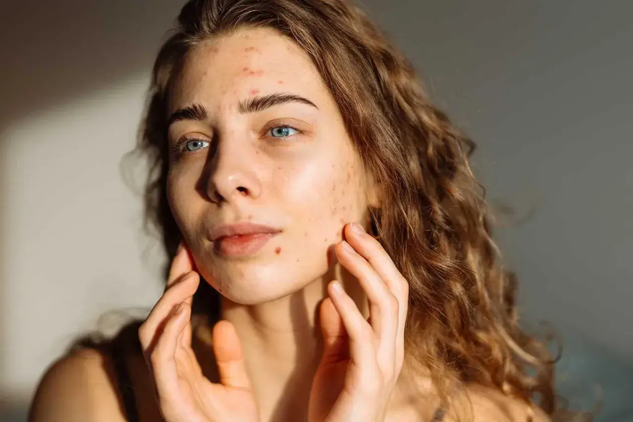 En ung kvinna med blå ögon och lockigt hår, som rör vid sitt ansikte där hon har acne i pannan och på kinderna.
