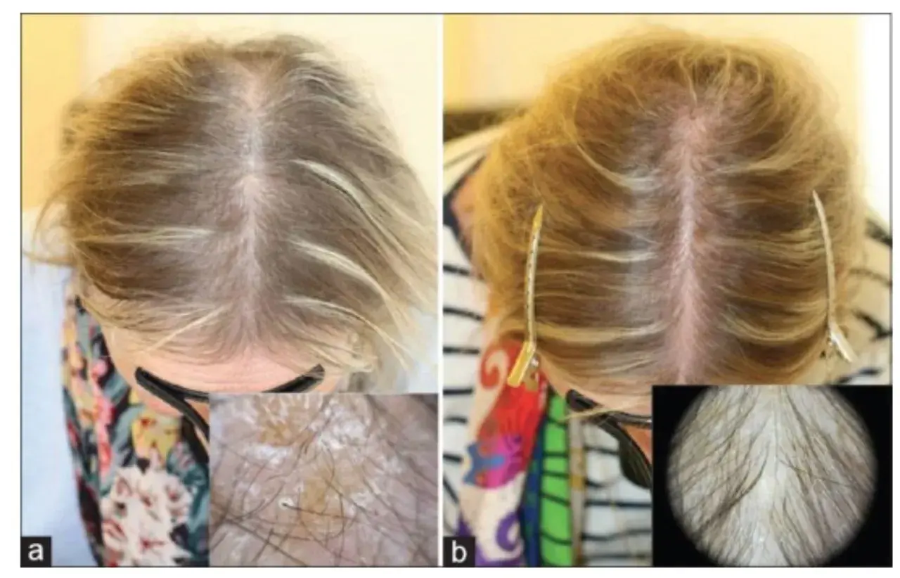 Före och efter bilder visar förbättrad hårväxt. Bild a visar tunt hår, bild b visar tätare hår. Biotin kan hjälpa mot håravfall.