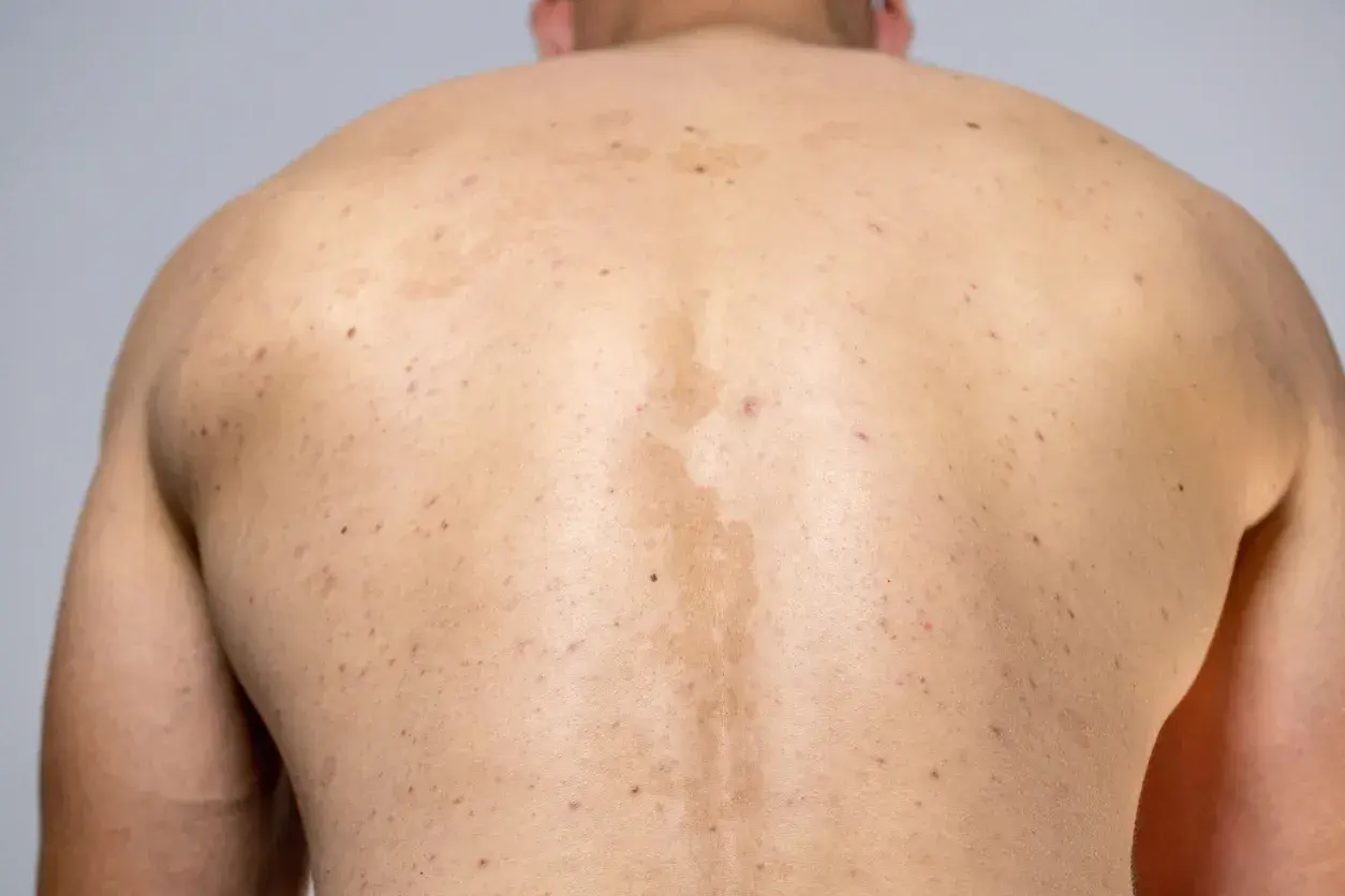 Rygg med fläckar och utslag, möjligen pityriasis versicolor.