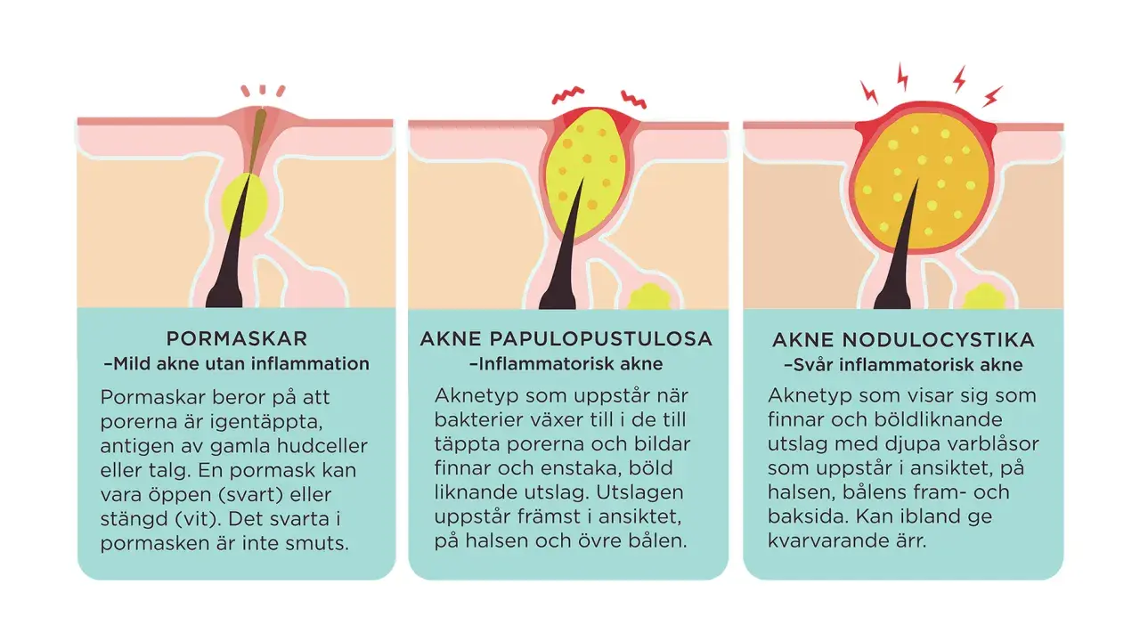 Illustrationer visar olika typer av finnar orsakade av igentäppta porer och inflammation, från milda pormaskar till svår akne.