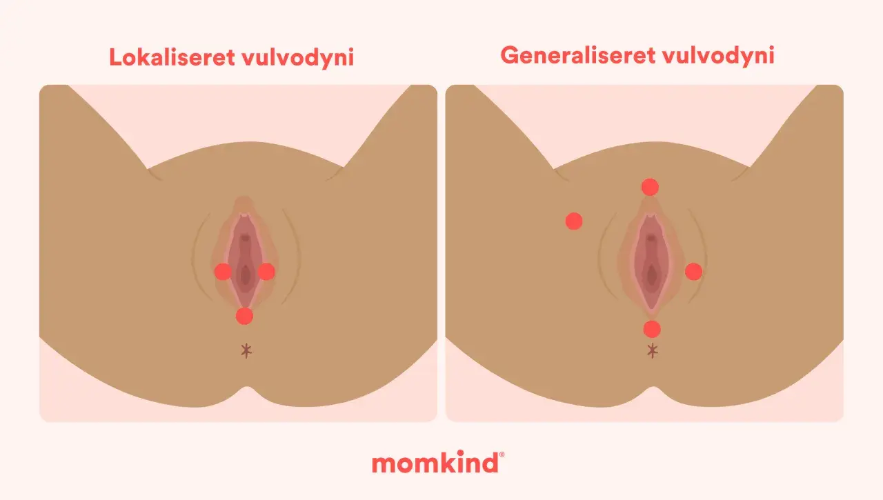 Illustration visar vulvodyni, lokaliserad och generaliserad, med röda prickar som markerar smärtpunkter. En känsla av sveda i underlivet kan uppstå.