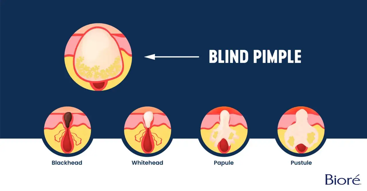 Illustration visar hur en inåt finne utvecklas från blackhead till pustule.