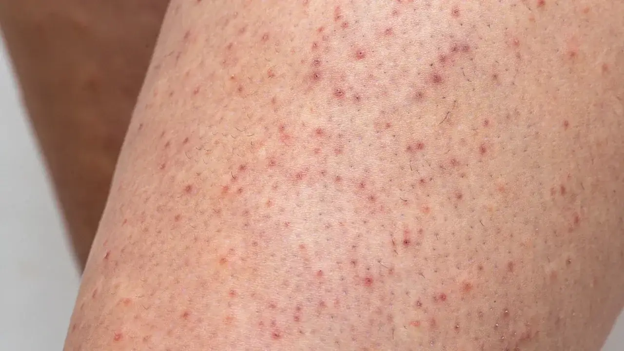 Närbild på irriterad hud efter rakning på benen, med små röda prickar och stubb.