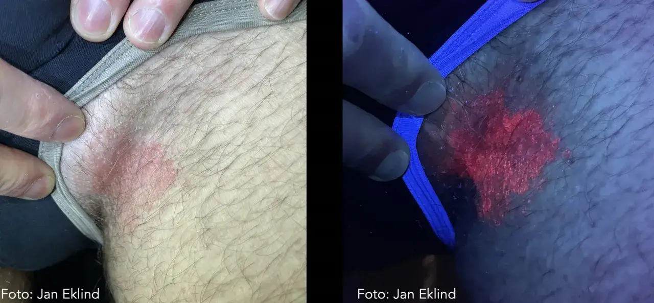 Tv&aring; bilder visar en hud&aring;komma i ljumsken. Den v&auml;nstra bilden visar en r&ouml;d, fj&auml;llande fl&auml;ck. Den h&ouml;gra bilden, tagen under UV-ljus, visar hur svampen lyser starkt r&ouml;tt.
