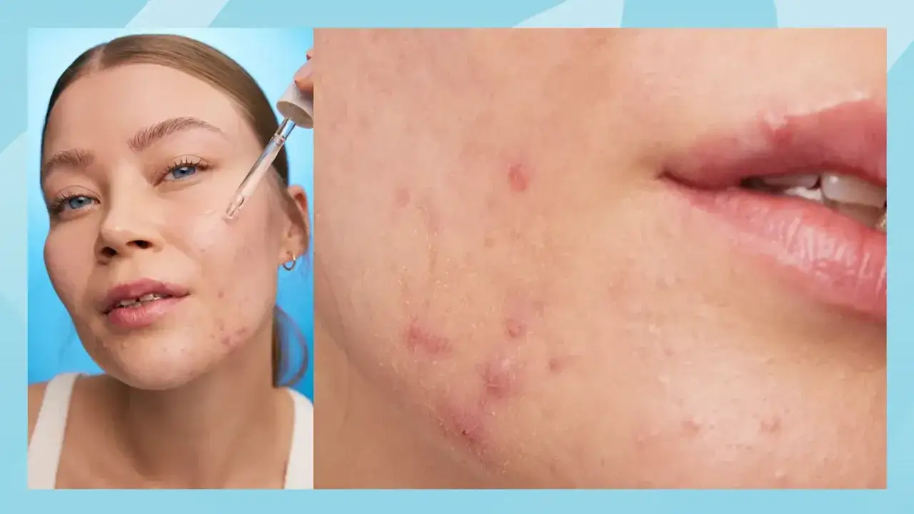N&auml;rbild p&aring; en kvinna som applicerar serum. Hennes hud har sm&aring; finnar runt munnen, vilket visar en vanlig hudutmaning.