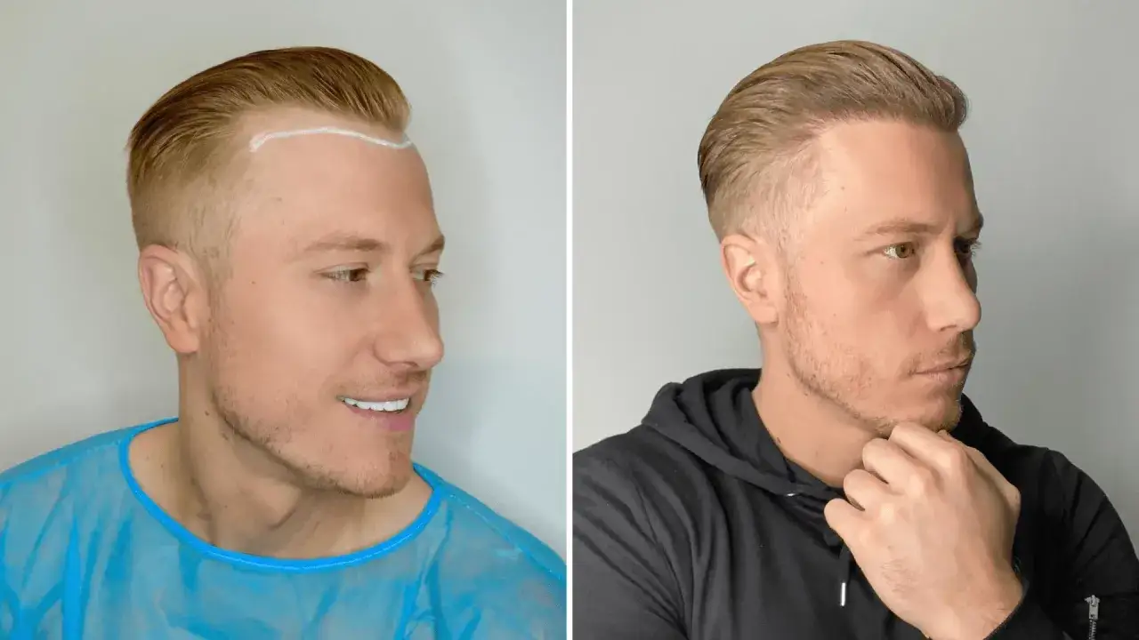 Före och efter bild på en man som genomgått en hårtransplantation. En vit linje markerar hårfästet före ingreppet.