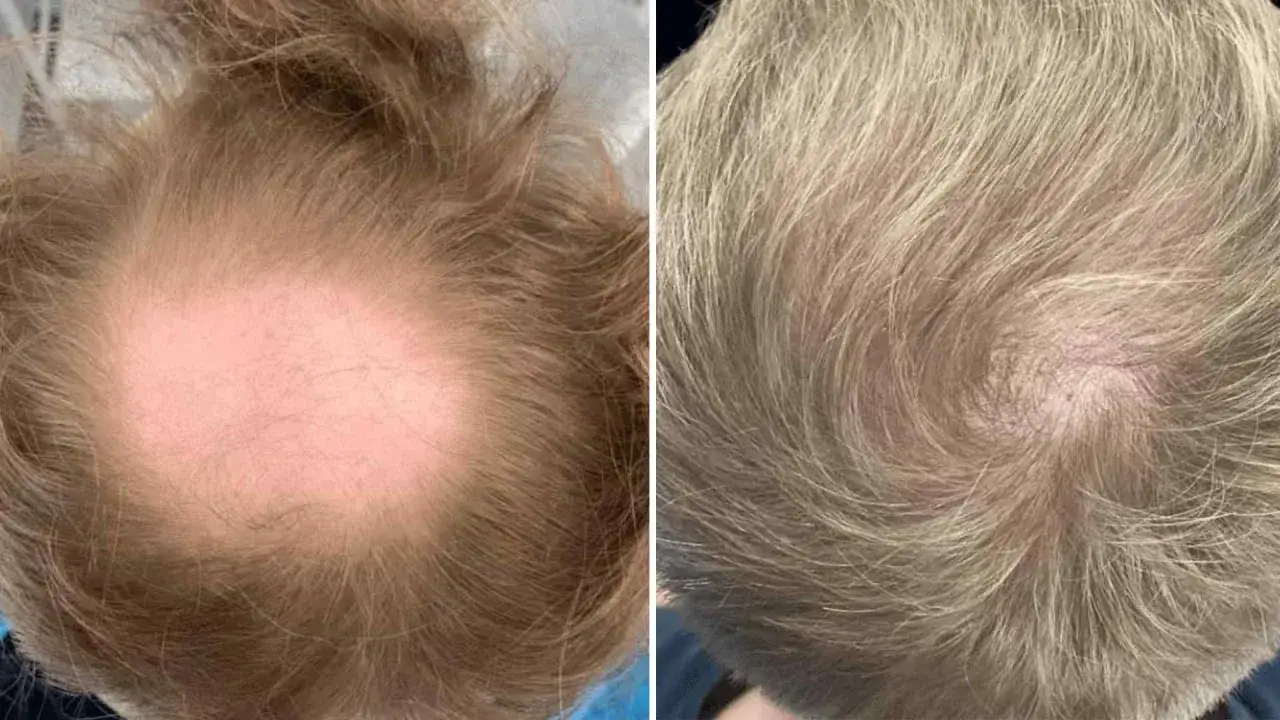 F&ouml;re- och efterbilder visar f&ouml;rb&auml;ttrad h&aring;rv&auml;xt efter behandling av testosteron h&aring;ravfall.