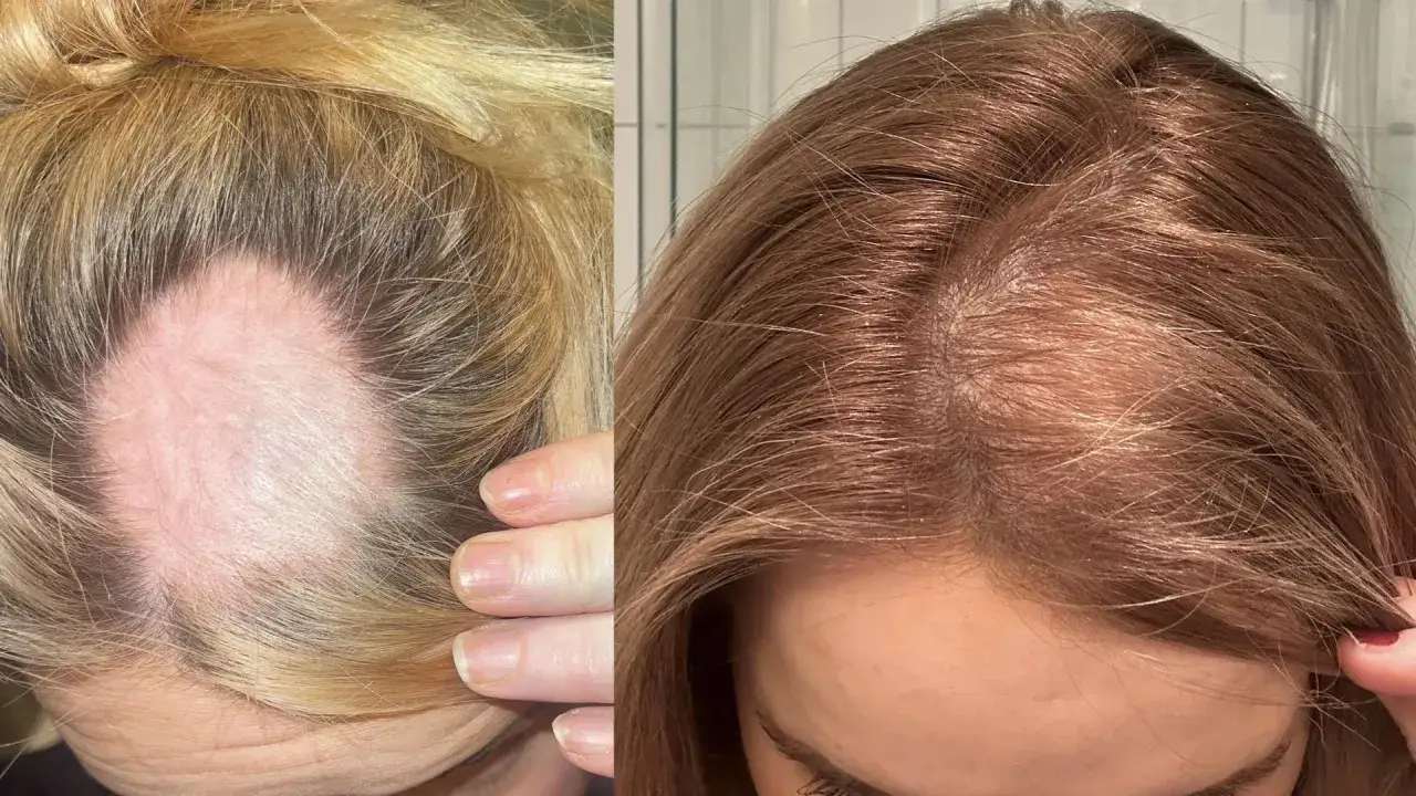 Före och efter bilder visar hårväxt efter alopecia areata behandling.