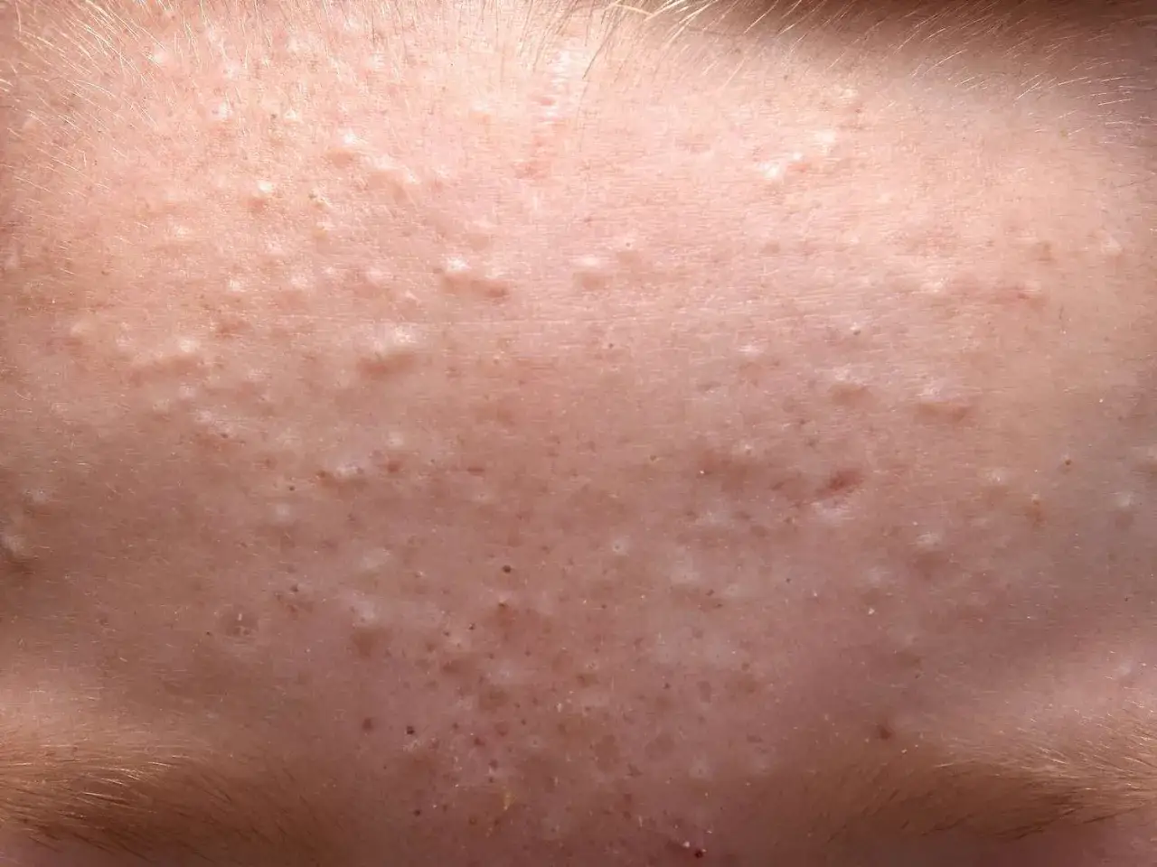Närbild på hud med små, vita knottror som indikerar keratosis pilaris i ansiktet.