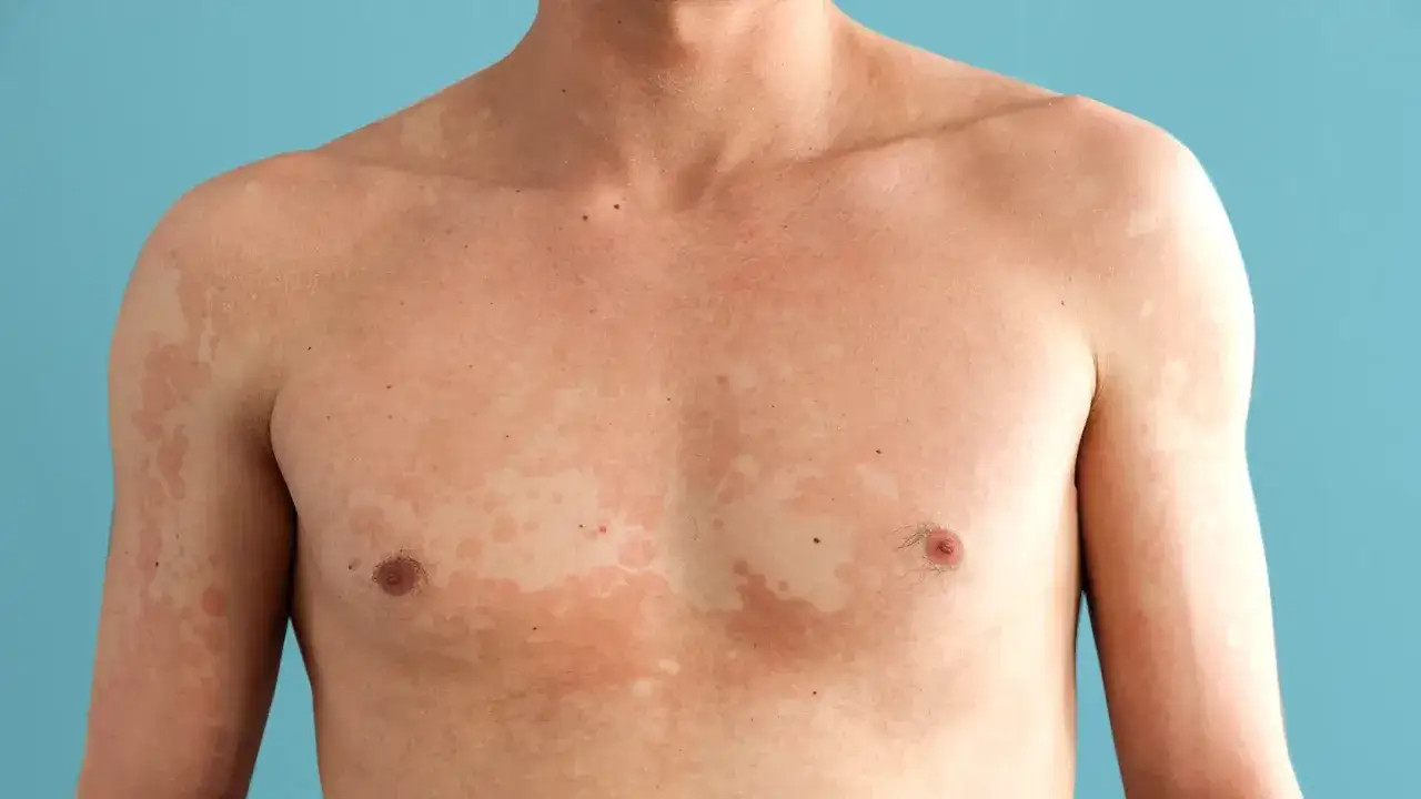 Hud med fläckar och missfärgningar, troligen pityriasis versicolor, på bröst och armar.