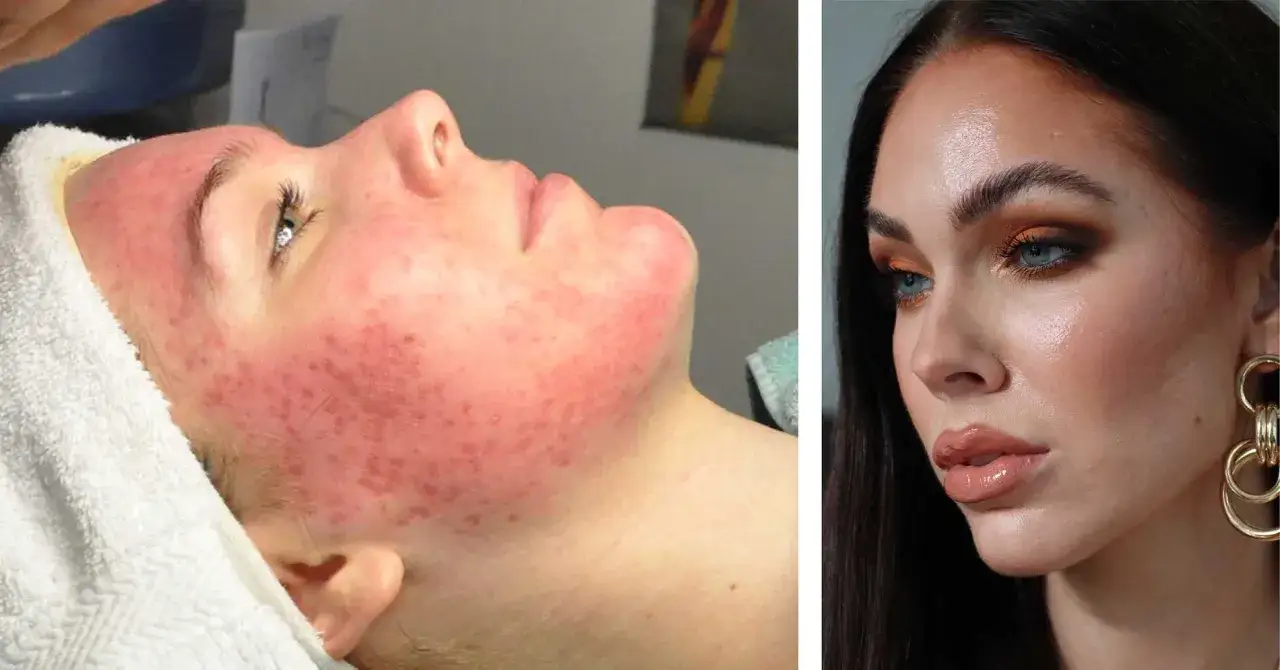 Före och efter: En person med en stor finne och rodnad i ansiktet, jämfört med en kvinna med perfekt makeup.