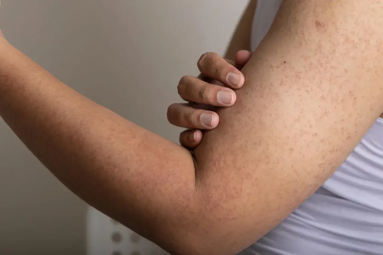 Nära bild på en arm med keratosis pilaris. Små knottror syns tydligt, vilket kan vara ett tecken på att en keratosis pilaris behandling behövs.