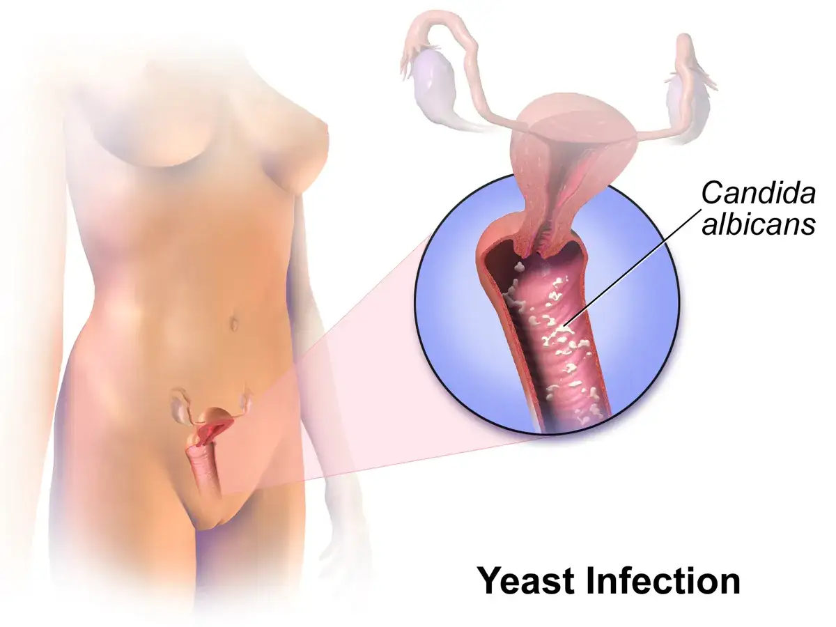 Illustration av en kvinnas underliv med en f&ouml;rstoring som visar Candida albicans, orsaken till sveda i underlivet.