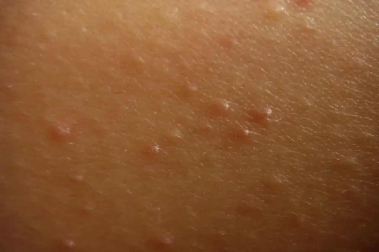 Närbild på hud med små, upphöjda prickar som indikerar keratosis pilaris.