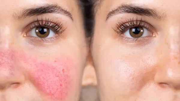 Före- och efterbild som visar effekten av hudvård för rosacea. Vänster sida visar rodnad och synliga blodkärl, höger sida visar en lugnare hud.