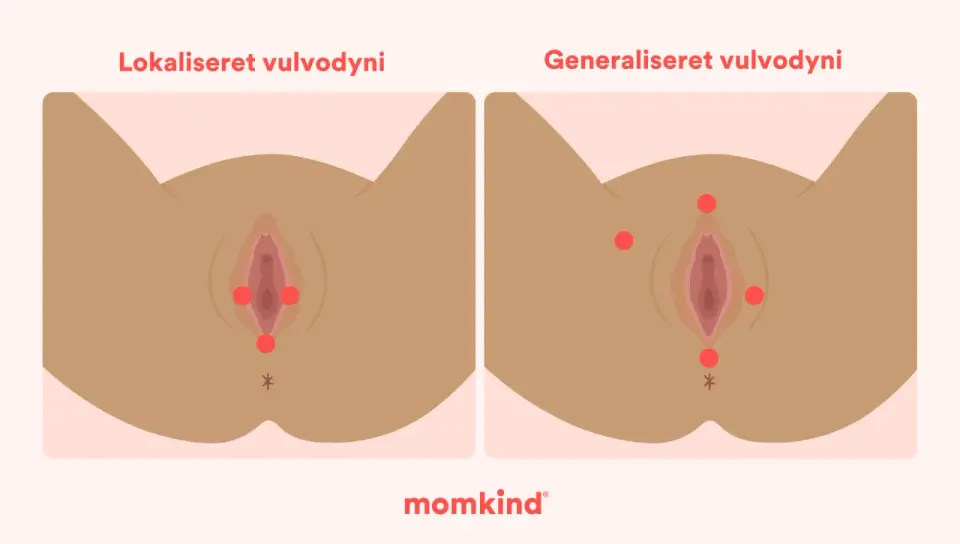 Sveda i underlivet - Orsaker, lindring och när du söker vård